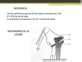 INCIDENCIA
Lámina epifisaria proximal 5% de todas las lesiones de fisis
4.5-10% de las de codo
En promedio se producen a los 10 -13 años de edad

MECANISMO DE LA
LESIÓN

 