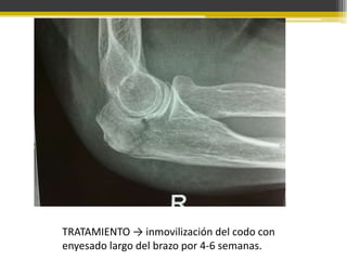 TRATAMIENTO → inmovilización del codo con
enyesado largo del brazo por 4-6 semanas.

 