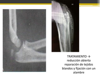TRATAMIENTO →
reducción abierta
reparación de tejidos
blandos y fijación con un
alambre

 