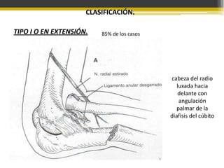 CLASIFICACIÓN.
TIPO I O EN EXTENSIÓN.

85% de los casos

cabeza del radio
luxada hacia
delante con
angulación
palmar de la
diafisis del cúbito

 