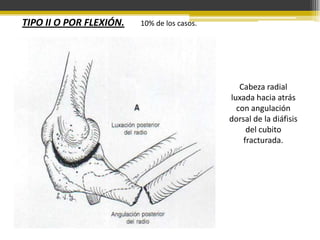 TIPO II O POR FLEXIÓN.

10% de los casos.

Cabeza radial
luxada hacia atrás
con angulación
dorsal de la diáfisis
del cubito
fracturada.

 