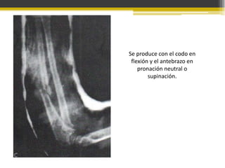 Se produce con el codo en
flexión y el antebrazo en
pronación neutral o
supinación.

 