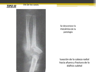 TIPO III

5% De los casos.

Se desconoce la
mecánica de la
patología

luxación de la cabeza radial
hacia afuera y fractura de la
diáfisis cubital

 