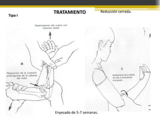 Tipo I

TRATAMIENTO

Enyesado de 5-7 semanas.

Reducción cerrada.

 