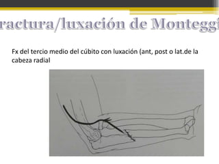 Fx del tercio medio del cúbito con luxación (ant, post o lat.de la
cabeza radial

 