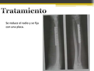 Se reduce el radio y se fija
con una placa.

 