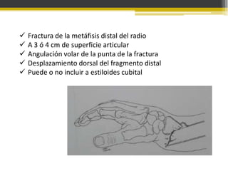 





Fractura de la metáfisis distal del radio
A 3 ó 4 cm de superficie articular
Angulación volar de la punta de la fractura
Desplazamiento dorsal del fragmento distal
Puede o no incluir a estiloides cubital

 