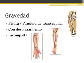 Gravedad
• Fisura / Fractura de trozo capilar
• Con desplazamiento

• Incompleta

 