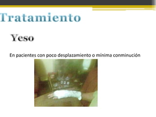 En pacientes con poco desplazamiento o mínima conminución

 