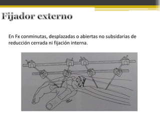 En Fx conminutas, desplazadas o abiertas no subsidarias de
reducción cerrada ni fijación interna.

 