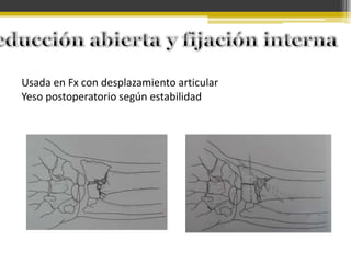 Usada en Fx con desplazamiento articular
Yeso postoperatorio según estabilidad

 