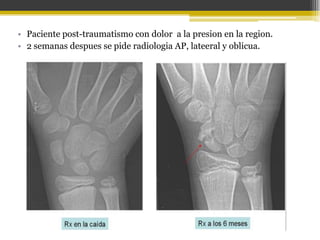 • Paciente post-traumatismo con dolor a la presion en la region.
• 2 semanas despues se pide radiologia AP, lateeral y oblicua.

 
