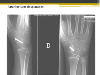 Para fracturas desplazadas:

 