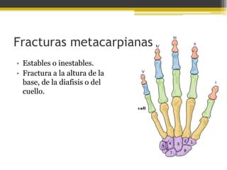 Fracturas metacarpianas
• Estables o inestables.
• Fractura a la altura de la
base, de la diafisis o del
cuello.

 
