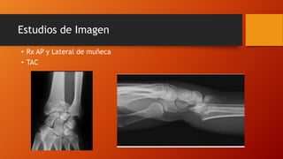 Estudios de Imagen
• Rx AP y Lateral de muñeca
• TAC
 