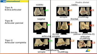 Fracturas de muñeca.pptx