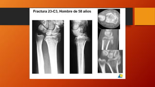 Fracturas de muñeca.pptx