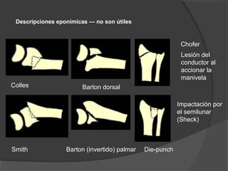 Descripciones eponímicas — no son útiles
Colles Barton dorsal
Chofer
Lesión del
conductor al
accionar la
manivela
Smith Barton (invertido) palmar Die-punch
Impactación por
el semilunar
(Sheck)
 