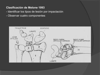 Clasificación de Melone 1993
- Identificar los tipos de lesión por impactación
- Observar cuatro componentes
 