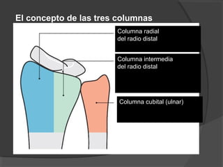 El concepto de las tres columnas
Rikli, Regazzoni
J Bone Joint Surg 1996
Columna radial
del radio distal
Columna intermedia
del radio distal
Columna cubital (ulnar)
 