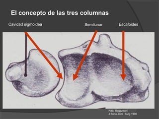 Cavidad sigmoidea Semilunar Escafoides
Rikli, Regazzoni
J Bone Joint Surg 1996
El concepto de las tres columnas
 