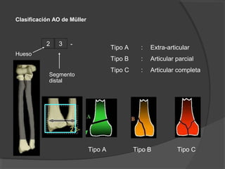 Clasificación AO de Müller
Segmento
distal
Hueso
-2 3
Tipo BTipo A
Tipo A : Extra-articular
Tipo B : Articular parcial
Tipo C : Articular completa
Tipo C
 