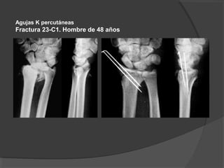 Agujas K percutáneas
Fractura 23-C1. Hombre de 48 años
 
