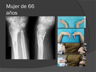 Mujer de 66
años
A los 2 años postoperatorios
 