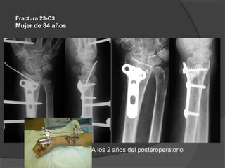 Fractura 23-C3
Mujer de 84 años
A los 2 años del posteroperatorio
 
