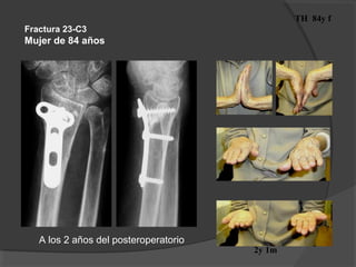 TH 84y f
2y 1m
Fractura 23-C3
Mujer de 84 años
A los 2 años del posteroperatorio
 