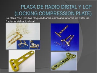 La placa “con tornillos bloqueados” ha cambiado la forma de tratar las
fracturas del radio distal
 