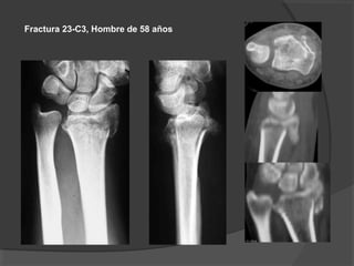 Fractura 23-C3, Hombre de 58 años
 
