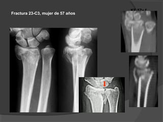 KF 57y f
Fractura 23-C3, mujer de 57 años
 