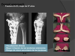 8 m
Dorsal approach
- Visualización directa
- Mayor irritación de los tendones extensores
- Riesgo de rotura secundaria de los tendones
Fractura 23-C3, mujer de 57 años
 