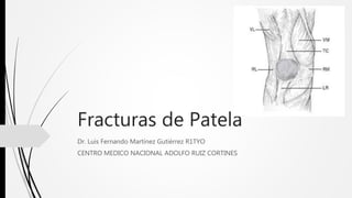 Fracturas de Patela
Dr. Luis Fernando Martínez Gutiérrez R1TYO
CENTRO MEDICO NACIONAL ADOLFO RUIZ CORTINES
 