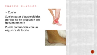 C u a d r o c l í n i c o
¬ Cuello
Suelen pasar desapercibidas
porque no se desplazan tan
frecuentemente
Puede confundirse con un
esguince de tobillo
 