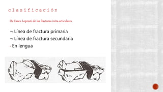 c l a s i f i c a c i ó n
¬ Línea de fractura primaria
¬ Línea de fractura secundaria
- En lengua
De Essex-Lopresti de las fracturas intra-articulares
 