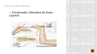 t r a t a m i e n t o
¬ Conservador: Maniobra de Essex-
Lopresti
 