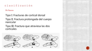 c l a s i f i c a c i ó n
Tipo I: Fracturas de cortical dorsal
Tipo II: Fractura prolongada del cuerpo
navicular
Tipo III: Fractura que atraviesa las dos
corticales
De Saxena
 