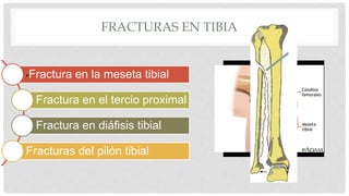 FRACTURAS EN TIBIA
•Fractura en la meseta tibial
Fractura en el tercio proximal
Fractura en diáfisis tibial
Fracturas del pilón tibial
 