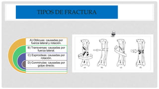 TIPOS DE FRACTURA
A) Oblicuas: causadas por
fuerza lateral y rotación.
B) Transversas: causadas por
fuerza lateral.
C) Espiroideas: causadas por
rotación.
D) Conminutas: causadas por
golpe directo.
 