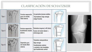 CLASIFICACIÓN DE SCHATZKER
 