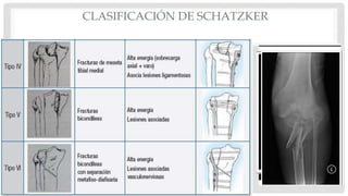 CLASIFICACIÓN DE SCHATZKER
 