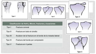 Clasificación de Hohl y Moore, fracturas y luxaciones
Tipo I Fractura coronal
Tipo II Fractura en todo el cóndilo
Tipo III Avulsion de la fractura en el borde de la meseta lateral
Tipo IV Fractura del borde por compresión
Tipo V Fractura en 4 partes
 