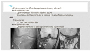 •TC
• Es importante identificar la depresión articular y trituración
• Recomendaciones
• Lipohemartrosis indica una fractura oculta
• Orientación del fragmento de la fractura y la planificación quirúrgica
•RM
• Indicaciones
• No está bien establecido
• Recomendaciones
• Útil para determinar la patología meniscal y ligamentosa
 