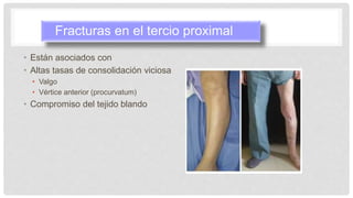 • Están asociados con
• Altas tasas de consolidación viciosa
• Valgo
• Vértice anterior (procurvatum)
• Compromiso del tejido blando
Fracturas en el tercio proximal
 