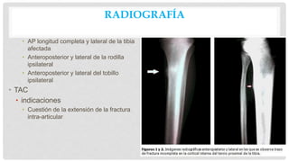 RADIOGRAFÍA
• AP longitud completa y lateral de la tibia
afectada
• Anteroposterior y lateral de la rodilla
ipsilateral
• Anteroposterior y lateral del tobillo
ipsilateral
• TAC
• indicaciones
• Cuestión de la extensión de la fractura
intra-articular
 