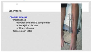Operatorio
•Fijación externa
•Indicaciones
•fracturas con amplio compromiso
de los tejidos blandos
•politraumatismos
•fijadores son útiles
 
