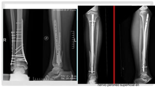 •Enclavado intramedular
•Indicaciones
•Suficiente hueso proximal para aceptar
dos tornillos de bloqueo (5-6 cm)
•Resultados
•Altas tasas de mala unión con una
técnica inadecuada
•Más mala unión común
•Valgo
•Vértice anterior (procurvatum)
•Placa de fijación
percutánea
•Indicaciones
•Inadecuada fijación proximal para
IM clavado
El más adecuado para las fracturas
transversales u oblicuas
•mínimo compromiso de los tejidos
blandos
•Técnica
•Puede utilizarse medial o lateral
•Mejor cobertura de tejidos blandos
lateralmente hace planchas
laterales más seguro
•Resultados
•Enchapado lateral con
conminución medial puede
conducir a un colapso en varo
•Placas largas pueden colocar
nervio peroneo superficial en
 