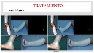 TRATAMIENTO
•Reducción cerrada / inmovilización con
yeso
•Indicaciones
•fxs de baja energía cerradas con la
alineación aceptable
•<5 grados varo-valgo angulación
•<10 grados anterior / posterior
angulación
•> 50% aposición cortical
•<1 cm acortamiento
•<Mala alineación 10 grados de
rotación
•si se desplaza realizar una
reducción cerrada bajo anestesia
general
•Técnica
•Colocar en la larga yeso en la pierna y
convertir a ortesis funcional a las 4
semanas
•Resultados
•Alta tasa de éxito si la alineación es
aceptable
•Riesgo de acortamiento con patrones
de fractura oblicua
•Riesgo de mala unión varo con
fracturas de tibia y un peroné diáfisis
intacta
•No unión se produce en el 1,1% de los
pacientes tratados con reducción
cerrada
No quirúrgico
 